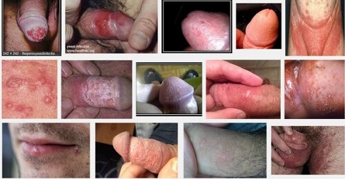 Viêm quy đầu do khuẩn Candida